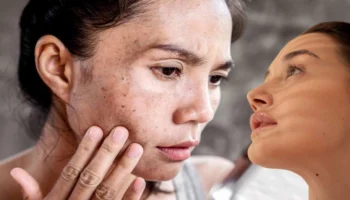 Tatil sonrası güneş lekeleri için ne yapmalı? Etkili cilt maskeleri