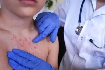 Uyuz iki haftada belirti veriyor, tedavi edilmezse yıllarca sürebiliyor