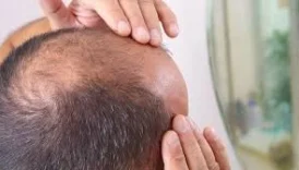 Saç Dökülmesine Umut Işığı