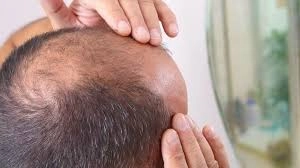 Saç Dökülmesine Umut Işığı